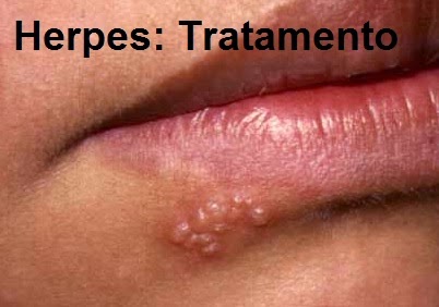 genitial herpes pics #10