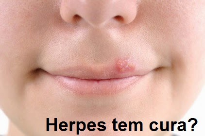 herpes simples