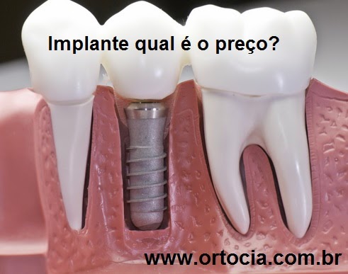 implante dentário preço