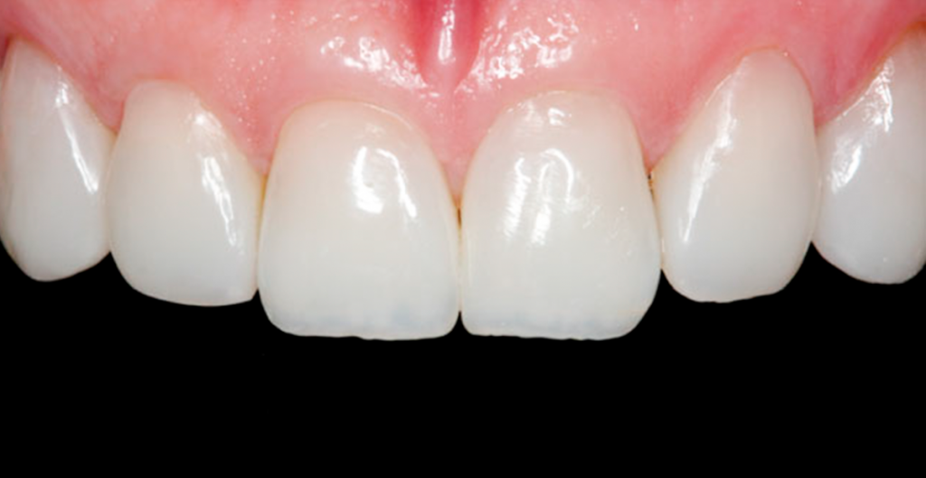dentes separados fechados com restauração em resina composta