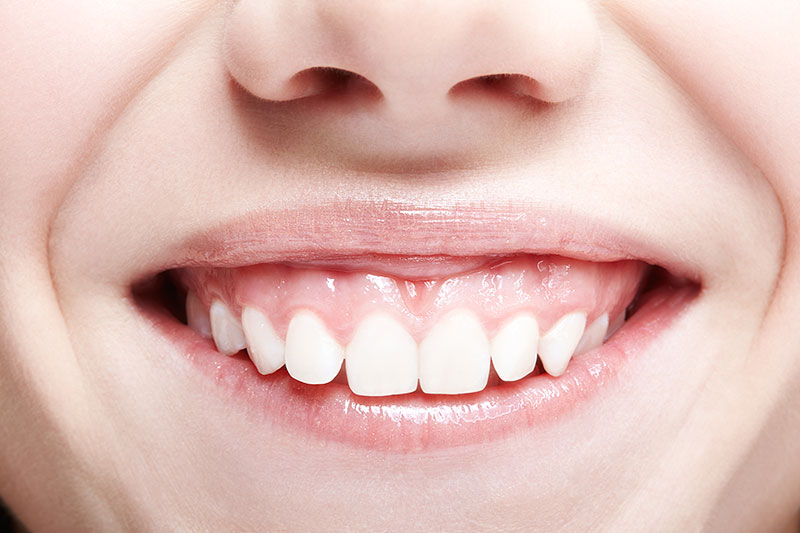 sorriso gengival